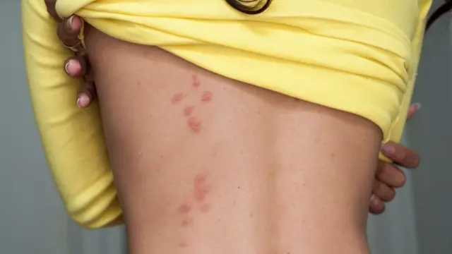 نیش ساس یا حشرات