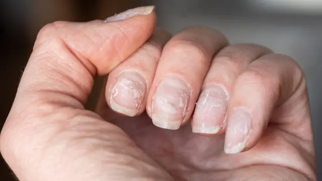 Unhas esbranquiçadas