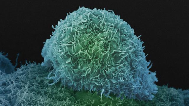 显微镜下的前列腺癌细胞