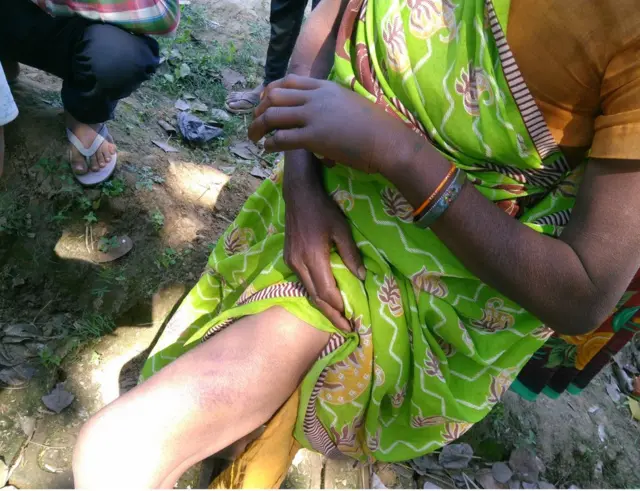 शरीर पर लगे ज़ख्म दिखाती हुई ग्रामीण महिला