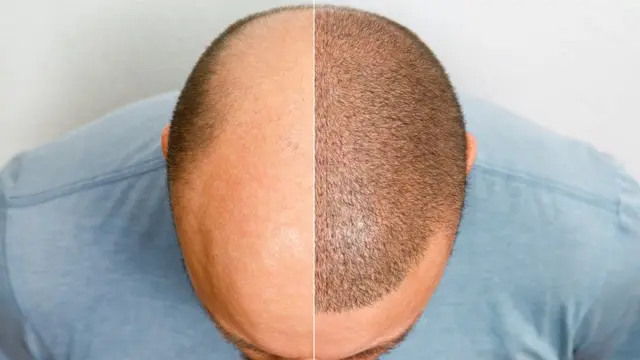 Topo da cabeçabet 77 ioum homem careca antes e depoisbet 77 iofazer transplante