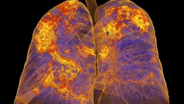 दिर्घ-कोभिड