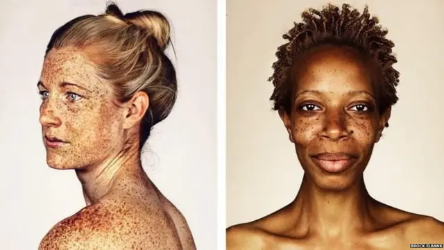 ફ્રેકલ્સ ધરાવતા લોકોની તસવીરો