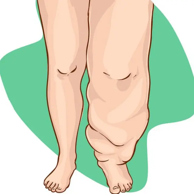 हत्तीरोग