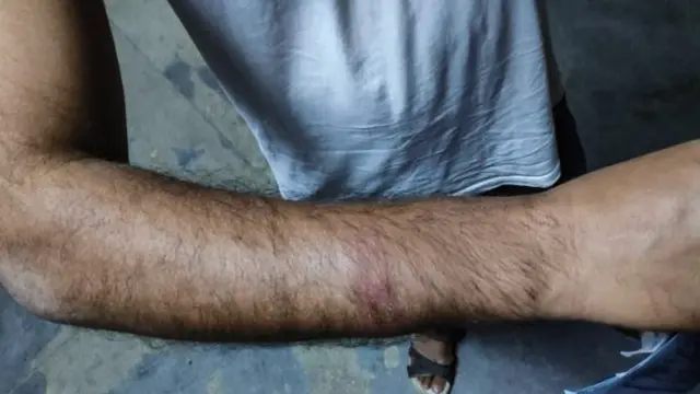प्रहरीको लाठी खाएपछि सुन्निएको हात