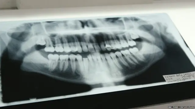 ਐੱਕਸ-ਰੇਅ ਵਿੱਚ ਨਜ਼ਰ ਆਉਂਦੇ ਐਲੇਕਸ ਦੇ ਟੁੱਟੇ ਦੰਦ