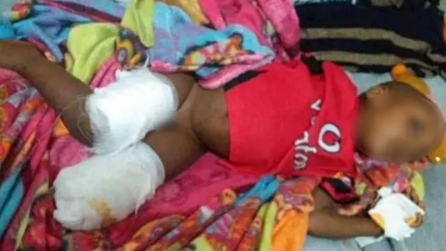 በከባድ መሣሪያ ጥቃት እግሩን ያጣው የሦስት ዓመቱ ዮናስ