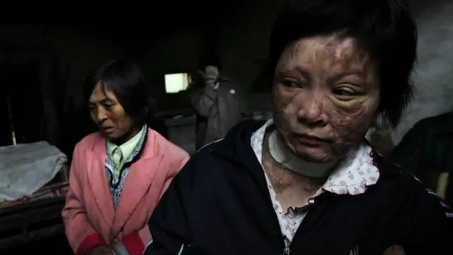 દાઝી ગયેલી મહિલાનો પ્રતીકાત્મક ફોટો