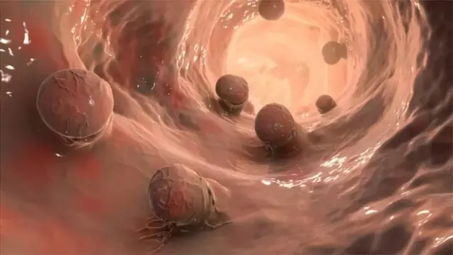 పురీషనాళంలో వచ్చే ట్యూమర్లకు సర్జరీ, రేడియోషన్, కీమోథెరపీ వంటి చికిత్సలు చేస్తారు