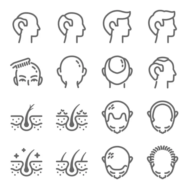 অ্যালোপেশিয়া