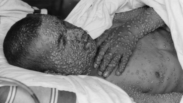 Paciente com varíola coberto de pústulas