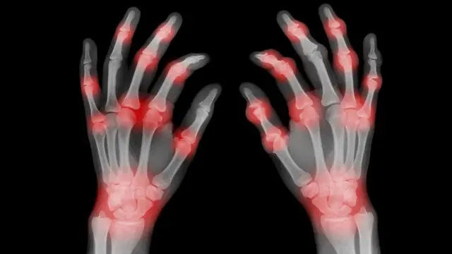 অটোইমিউন ডিজিজ: যে অসুখে শরীরের রোগ প্রতিরোধ ক্ষমতা সুস্থ অঙ্গ প্রত্যঙ্গকে আক্রমণ করে - BBC News বাংলা