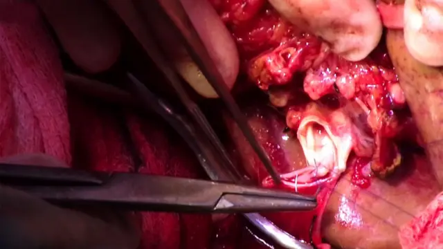 cosiendo la vena porta