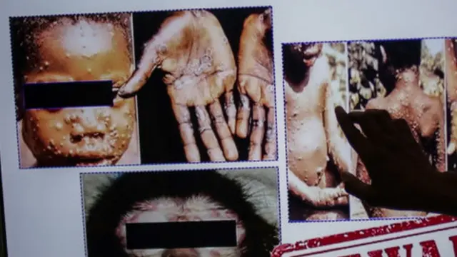 Des photos d'enfants atteints de la maladie