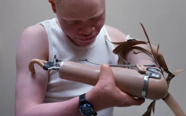 Emmanuel Rutema, a Tanzanian with Albinism who had his arm chopped off in a superstition-driven attack, tries to put on a new prosthetic arm at the Shriners Hospital in Philadelphia