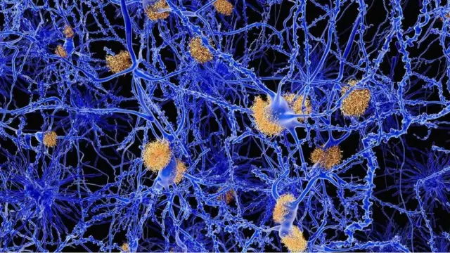 Ilustración de enlaces neuronales dañados