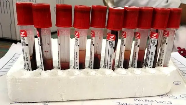 ਅਜੇ ਬਾਕੀ ਸੈਂਪਲਾਂ ਦੇ ਨਤੀਜਿਆਂ ਤੋਂ ਬਾਅਦ ਮਰੀਜ਼ਾਂ ਦੀ ਗਿਣਤੀ ਵੱਧ ਸਕਦੀ ਹੈ