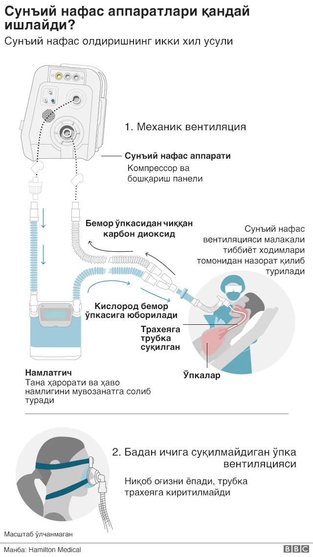 Сунъий ўпка вентиляцияси аппарати