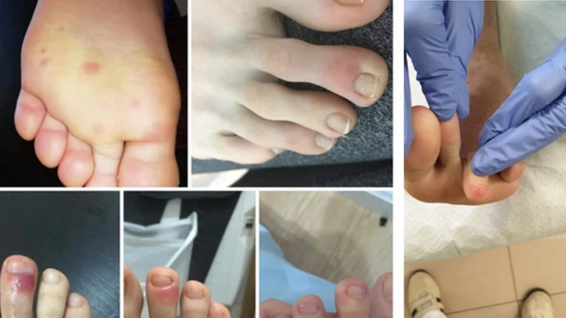 Симптомы (фото с сайта испанского совета ортопедов)