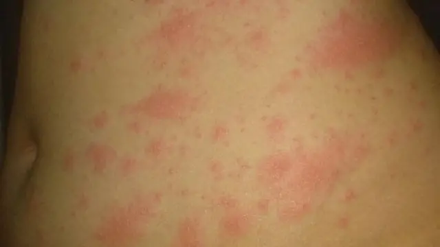 L'éruption la plus fréquente dans l'étude a touché près de la moitié des patients