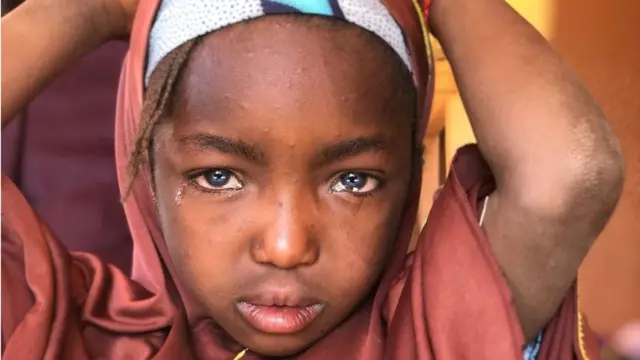 Nwata nwere Glaucoma