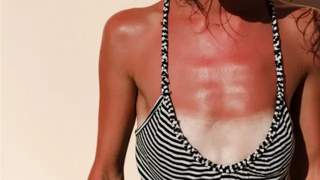 Ozbiljne opekotine od sunca