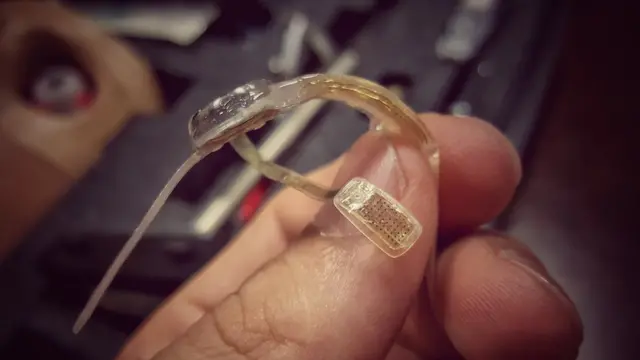 Имплант Argus II