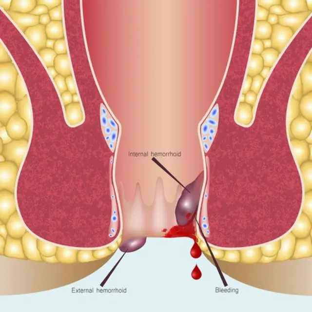 Hemorroidas
