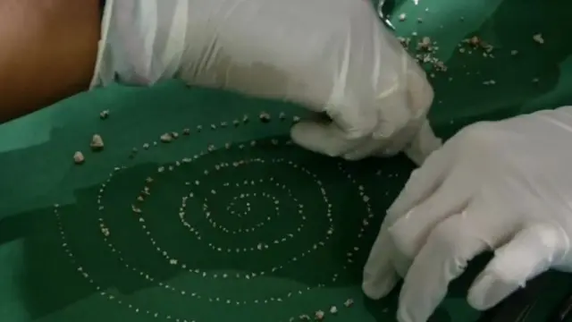 Ratusan gigi yang ditemukan di mulut seorang anak laki di India.