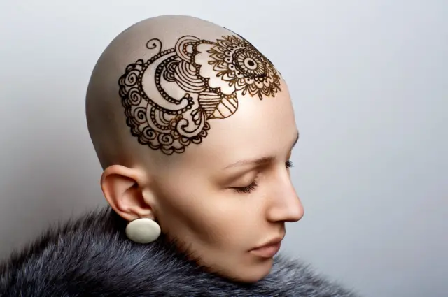 ઍલોપેશિયા