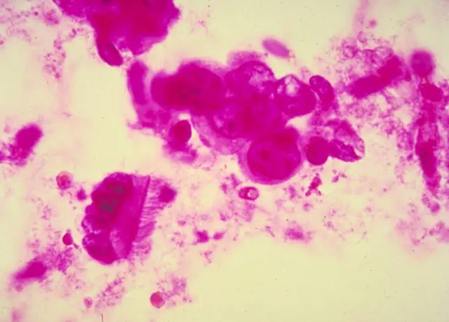 Células del cáncer de mama