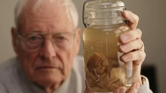 Thomas Harvey sosteniendo fragmentos del cerebro de Einstein.