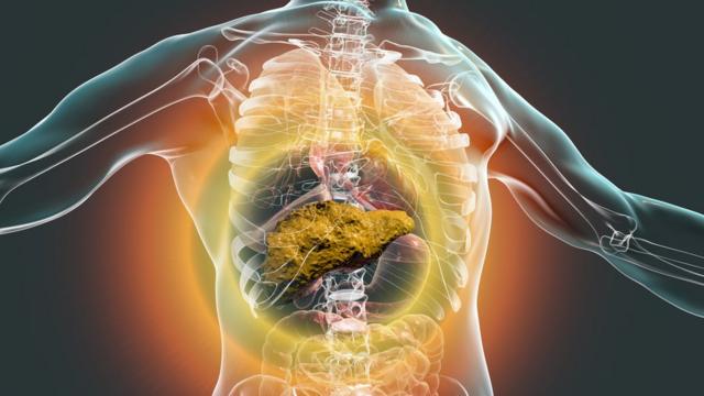 Ilustraçãobetsson limitacirrose hepática