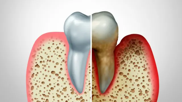 À esquerda, um dente normal, à direita, outro coberto com placa que causou inflamação nas gengivas