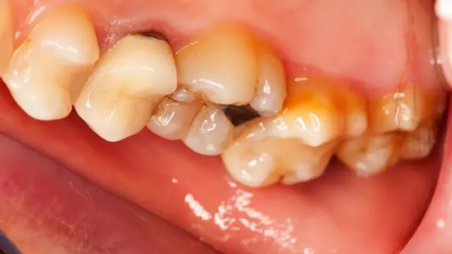 Boca com dentes corroídos