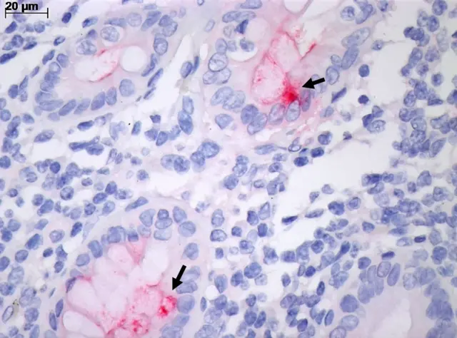 Intestino com inflamação pela Covid-19