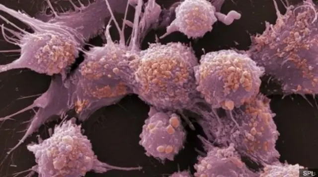 เซลล์มะเร็งต่อมลูกหมาก