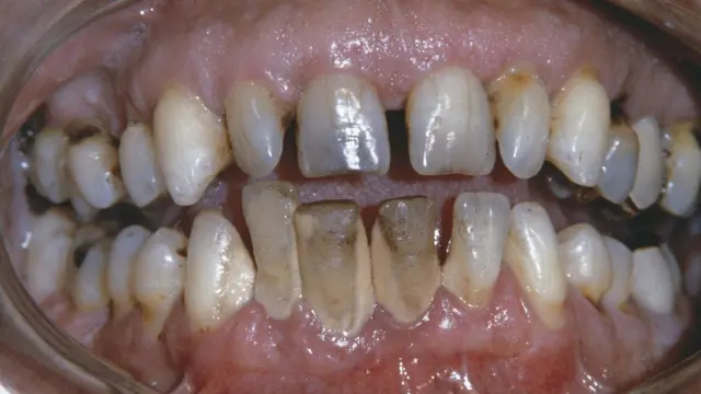 Eze Peridontitis na-enye nsogbu