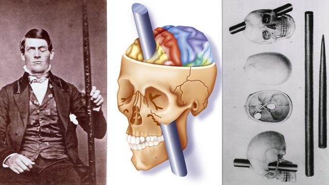菲尼亚斯·盖奇是人类医学史上的奇迹之一，对脑神经科学做出了无可替代的贡献