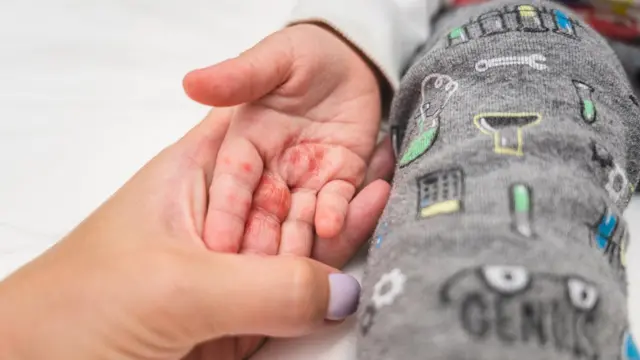 टोमेटो फ्लू