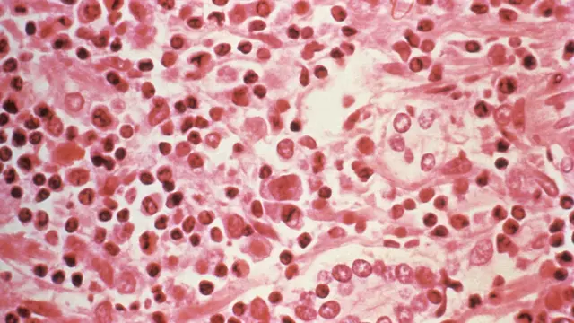 Estudo micrográfico de tecido hepático de um paciente com síndrome pulmonar por hantavírus (HPS)