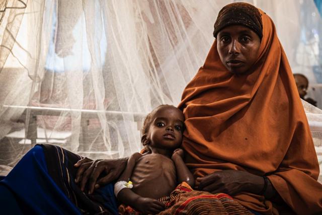 De nombreux enfants souffrent de graves problèmes de santé causés par le manque de nourriture en Somalie