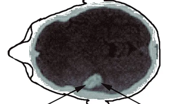 le cerveau de Bolte quand elle a eu son attaque.