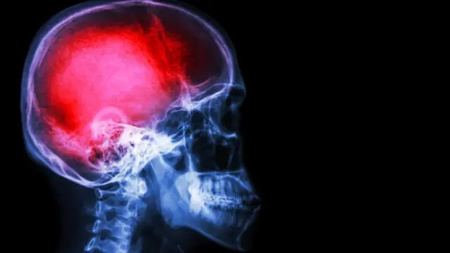 Radiografía del cerebro