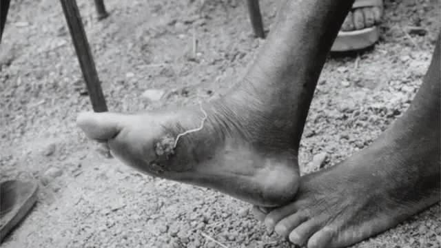 Guinea Worm