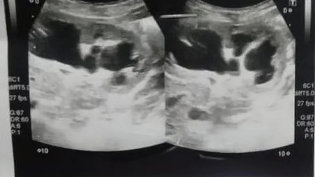 An ultrasound of baby Shazia's abdomen