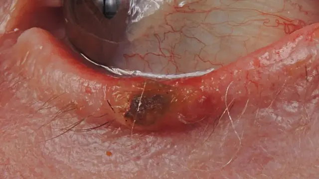 Carcinoma