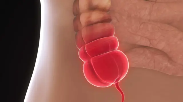 Imagem de um apêndice inflamado