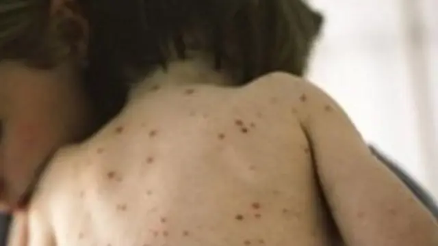 చికెన్ పాక్స్