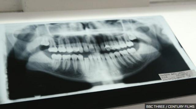 X-ray miệng Alex cho thấy hàm răng bị gãy